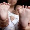 Baby Born With Thirty-One Fingers and Toes