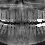 The End Of Root Canals?