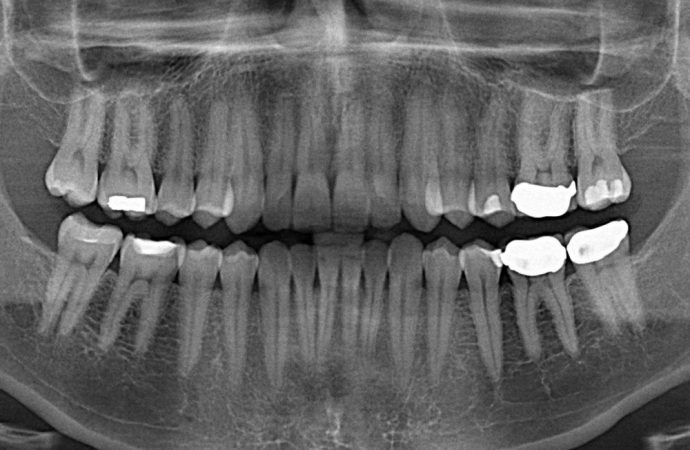 The End Of Root Canals?