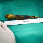 This strange ‘alien’ skeleton is actually a human fetus with genetic bone defects