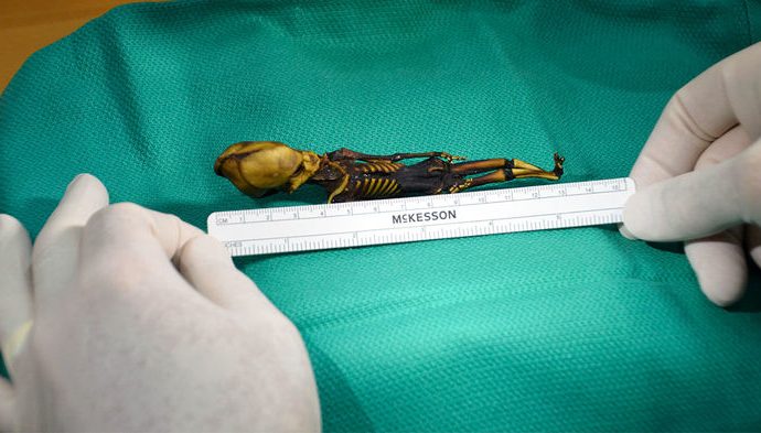 This strange ‘alien’ skeleton is actually a human fetus with genetic bone defects