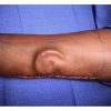 Army Surgeons Grow New Ear in Soldier’s Forearm