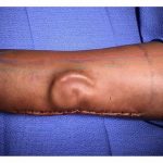 Army Surgeons Grow New Ear in Soldier’s Forearm