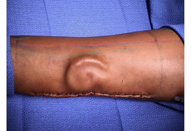 Army Surgeons Grow New Ear in Soldier’s Forearm