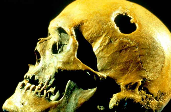 Why our ancestors drilled holes in each other’s skulls