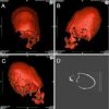 Can DNA solve the mystery of Europe’s pointy skulls?