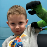 UK Boy First to Receive a Prosthetic Arm Above the Elbow