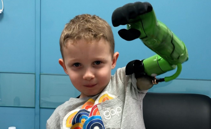 UK Boy First to Receive a Prosthetic Arm Above the Elbow