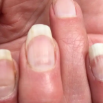 People are getting ‘COVID nails,’ and one expert says the unusual lines could be as useful as an antibody test to prove previous infection
