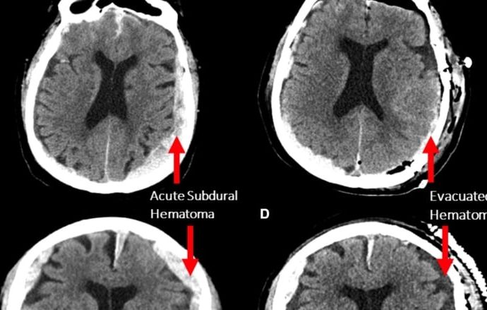 Does life flash before our eyes as we die? A Vancouver man’s brain scan suggests it’s possible